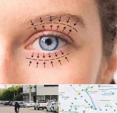 عمل افتادگی پلک در قدوسی شرقی شیراز