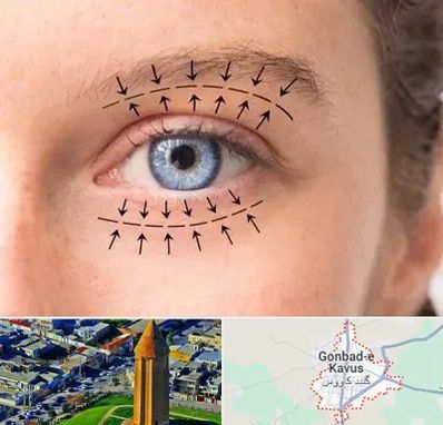 عمل افتادگی پلک در گنبد کاووس