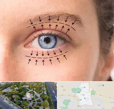 عمل افتادگی پلک در کاشمر