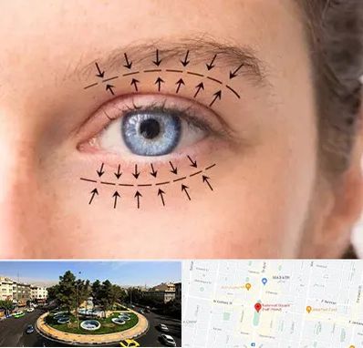 عمل افتادگی پلک در هفت حوض