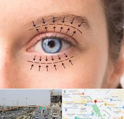 عمل افتادگی پلک در بلوار توس مشهد