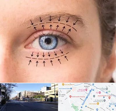 عمل افتادگی پلک در خیابان ملاصدرا شیراز