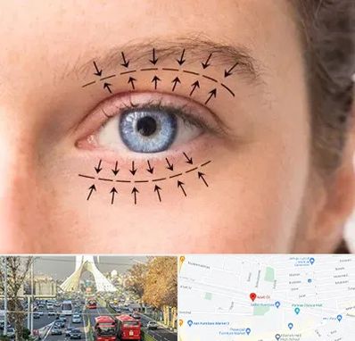 عمل افتادگی پلک در خیابان آزادی