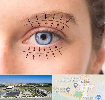 عمل افتادگی پلک در ملارد