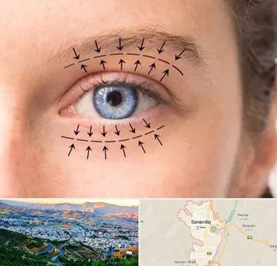 عمل افتادگی پلک در سنندج