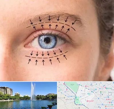 عمل افتادگی پلک در کوهسنگی مشهد