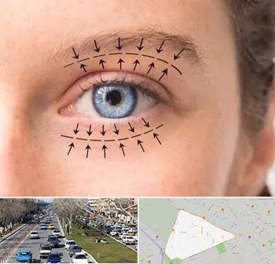 عمل افتادگی پلک در احمدآباد مشهد