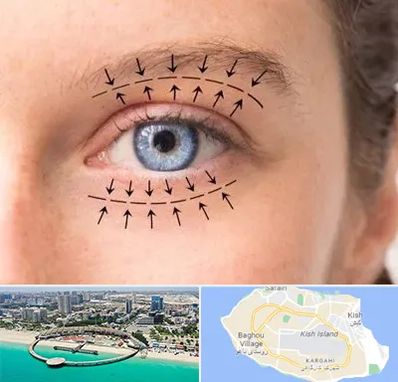 عمل افتادگی پلک در کیش