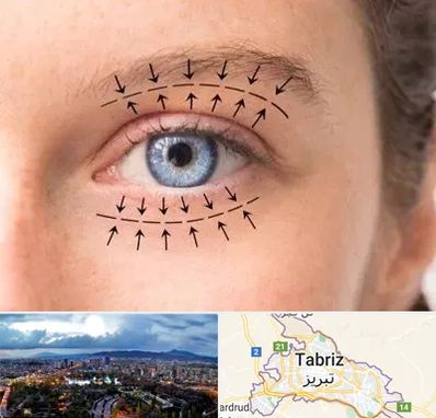 عمل افتادگی پلک در تبریز