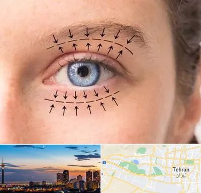 عمل افتادگی پلک در غرب تهران تهران