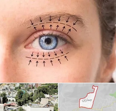 عمل افتادگی پلک در جماران