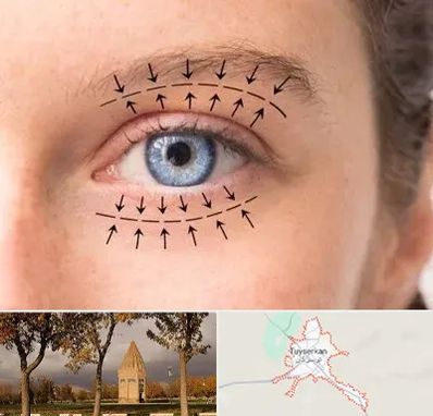 عمل افتادگی پلک در تویسرکان