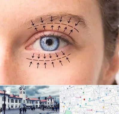 عمل افتادگی پلک در میدان شهرداری رشت