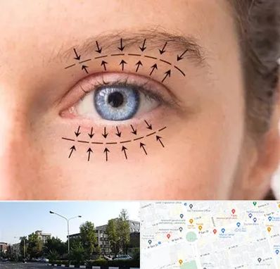 عمل افتادگی پلک در میدان کاج