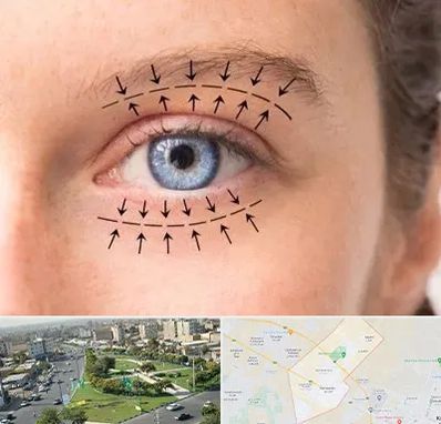 عمل افتادگی پلک در کمال شهر کرج