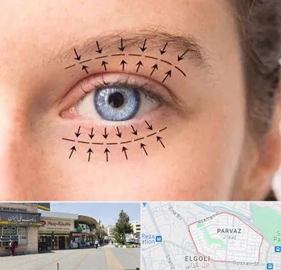 عمل افتادگی پلک در پرواز تبریز