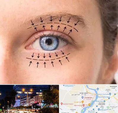 عمل افتادگی پلک در کیانپارس اهواز