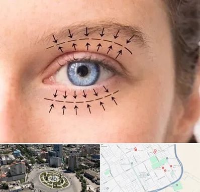 عمل افتادگی پلک در زرافشان اسلامشهر