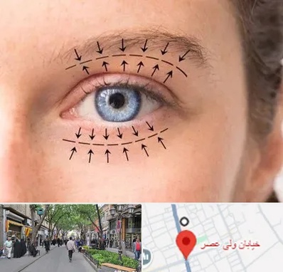 عمل افتادگی پلک در ولیعصر شهریار