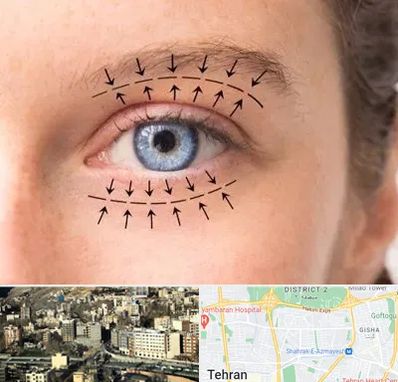 عمل افتادگی پلک در مرزداران