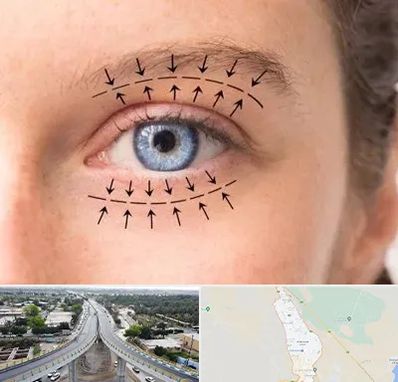 عمل افتادگی پلک در اندیمشک