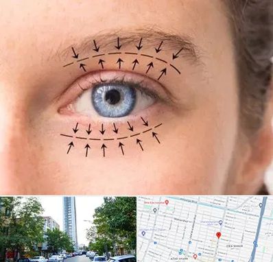 عمل افتادگی پلک در امامت مشهد