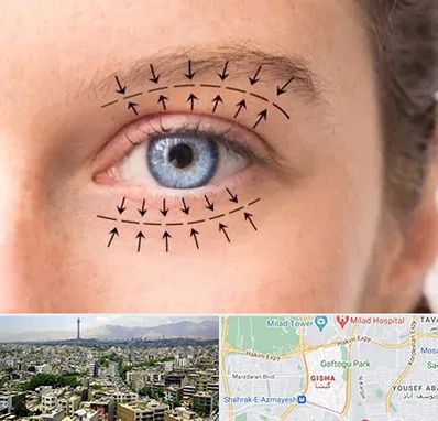 عمل افتادگی پلک در گیشا
