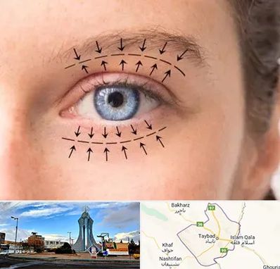 عمل افتادگی پلک در تایباد