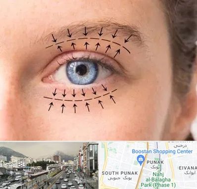 عمل افتادگی پلک در پونک