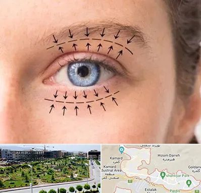 عمل افتادگی پلک در پردیس