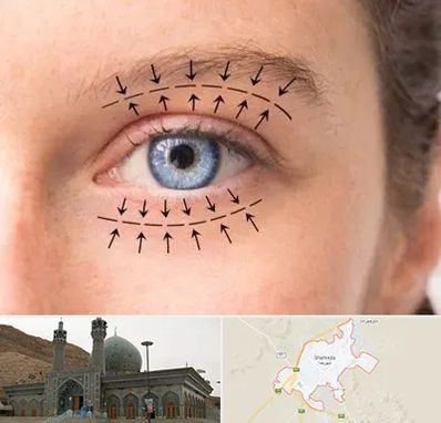 عمل افتادگی پلک در شهرضا