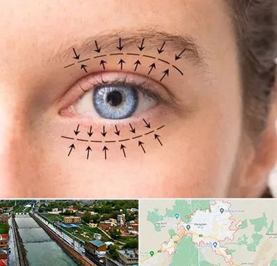 عمل افتادگی پلک در مراغه