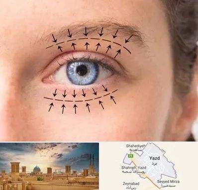 عمل افتادگی پلک در یزد