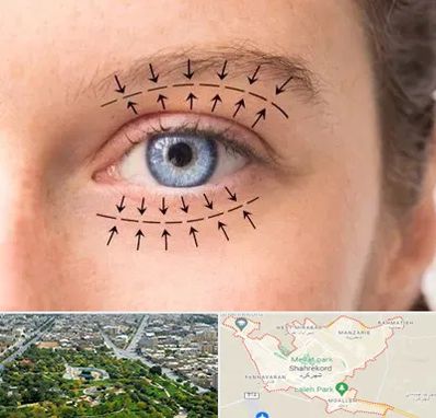 عمل افتادگی پلک در شهرکرد