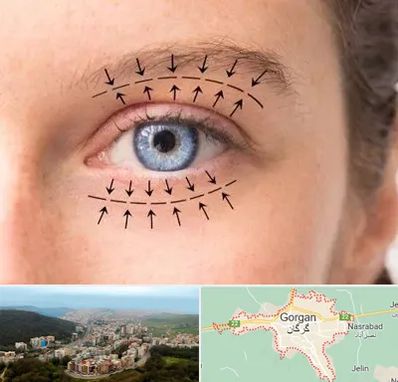 عمل افتادگی پلک در گرگان
