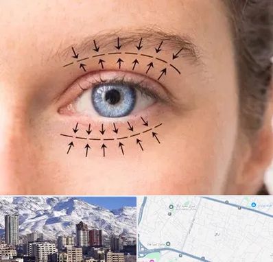 عمل افتادگی پلک در ازگل