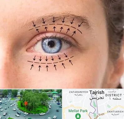 عمل افتادگی پلک در تجریش