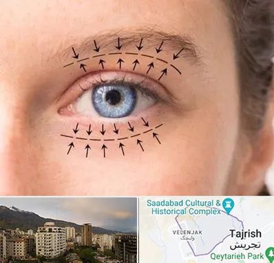 عمل افتادگی پلک در زعفرانیه