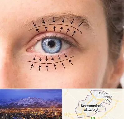 عمل افتادگی پلک در کرمانشاه