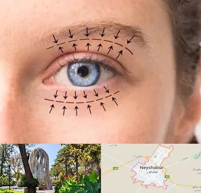 عمل افتادگی پلک در نیشابور