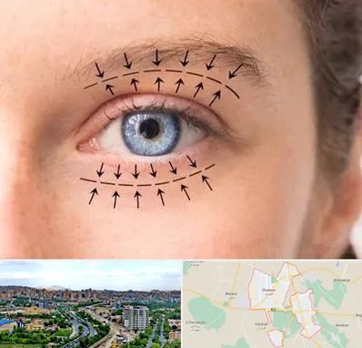 عمل افتادگی پلک در شهریار