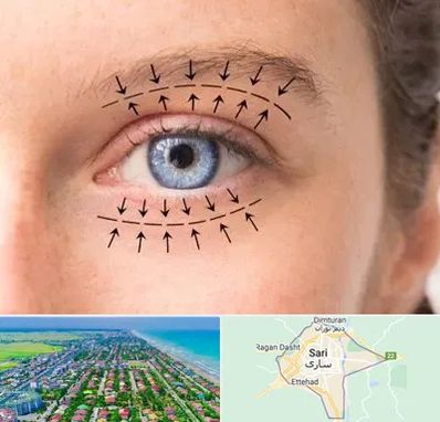 عمل افتادگی پلک در ساری