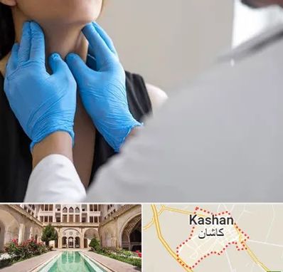دکتر سرطان گلو در کاشان