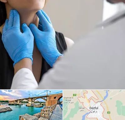 دکتر سرطان گلو در دزفول