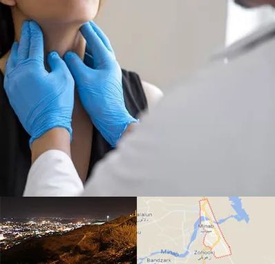 دکتر سرطان گلو در میناب