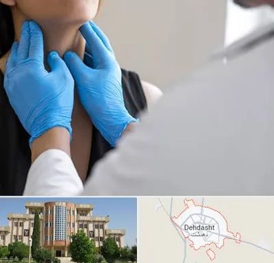 دکتر سرطان گلو در دهدشت