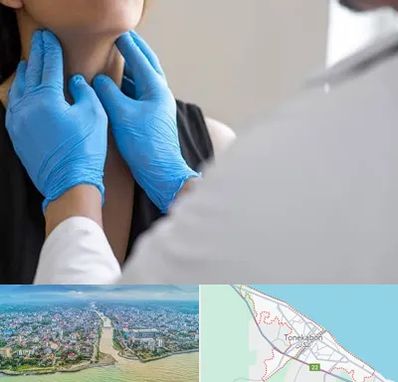 دکتر سرطان گلو در تنکابن
