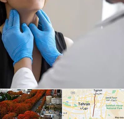 دکتر سرطان گلو در ولیعصر 