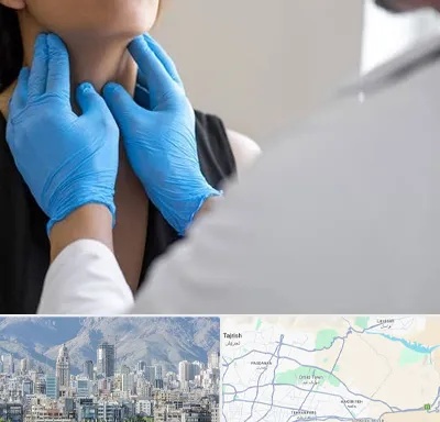 دکتر سرطان گلو در شمال شرق تهران
