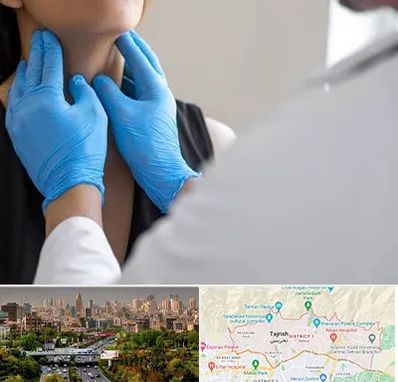 دکتر سرطان گلو در منطقه 1 تهران 